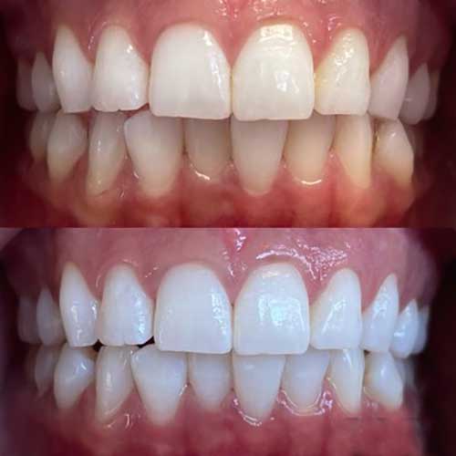 lowest cost of dental implants delhi