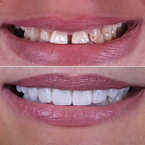 All on 4 Implants lowest cost in india