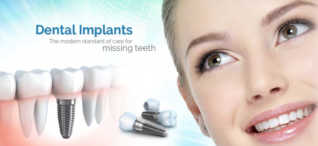 Implants dentistry