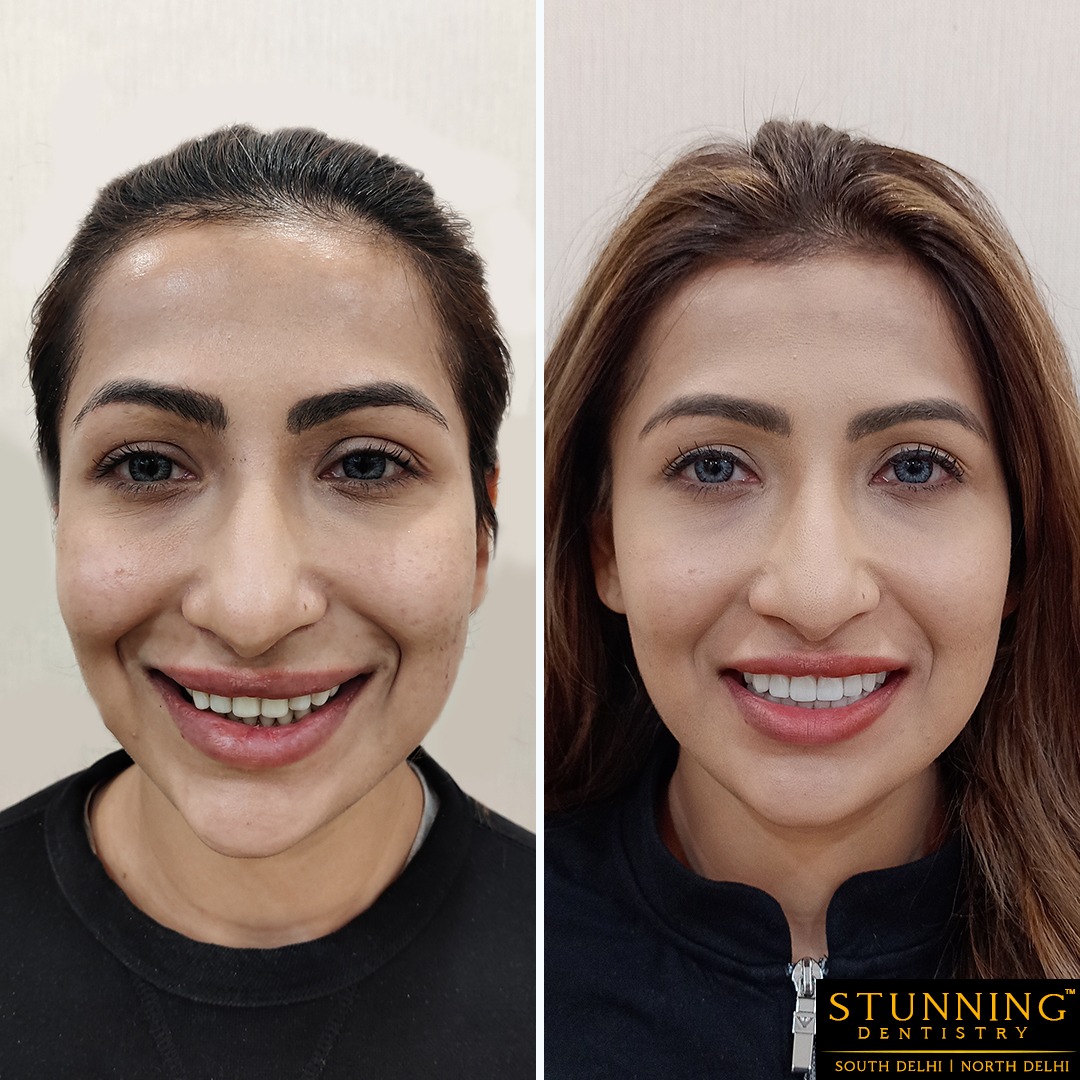 smile makeover results