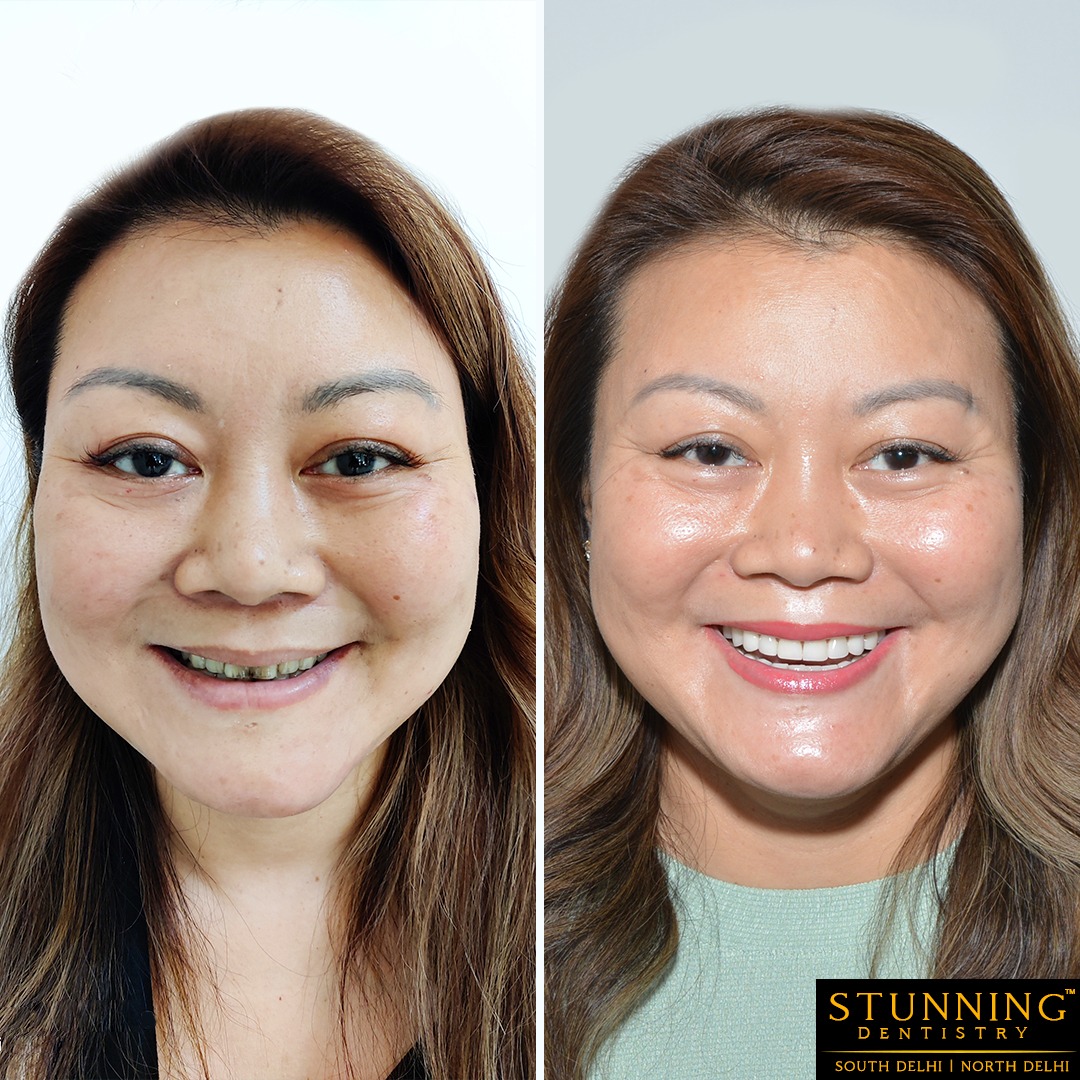 teeth correction results