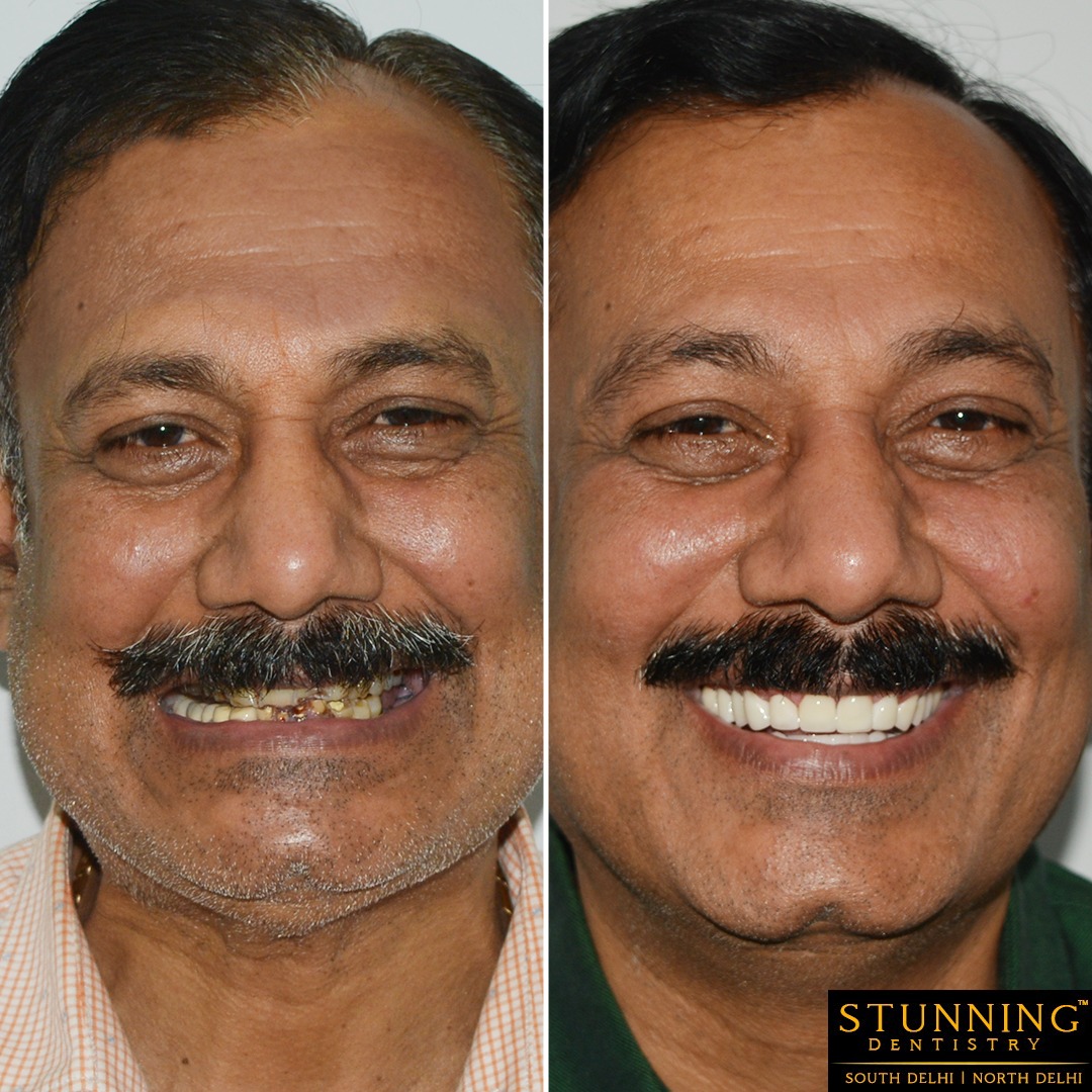 teeth correction results