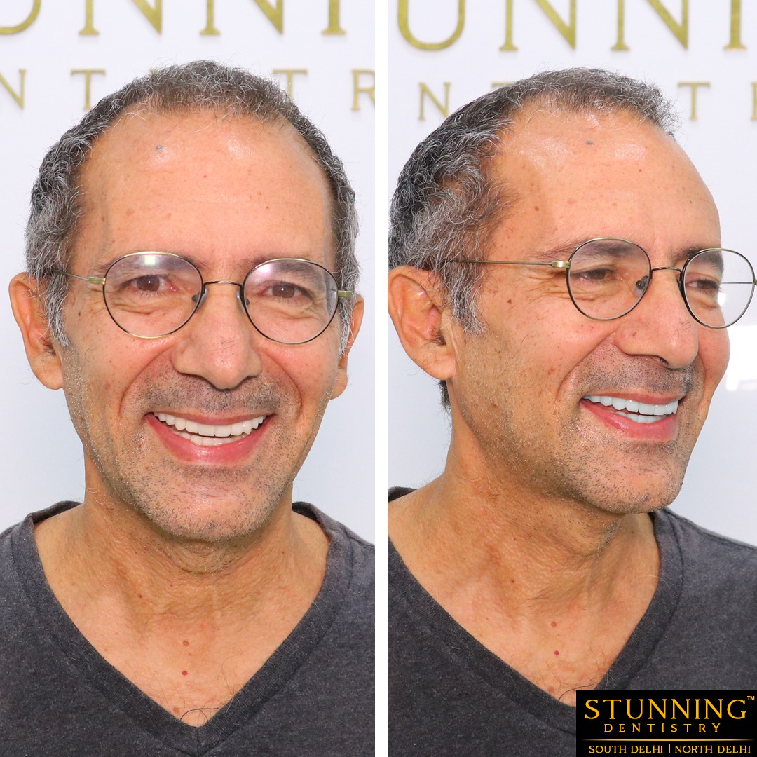 teeth correction results