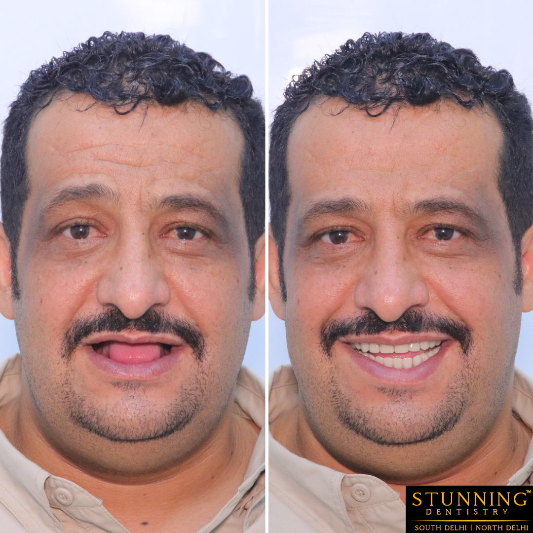 teeth correction results