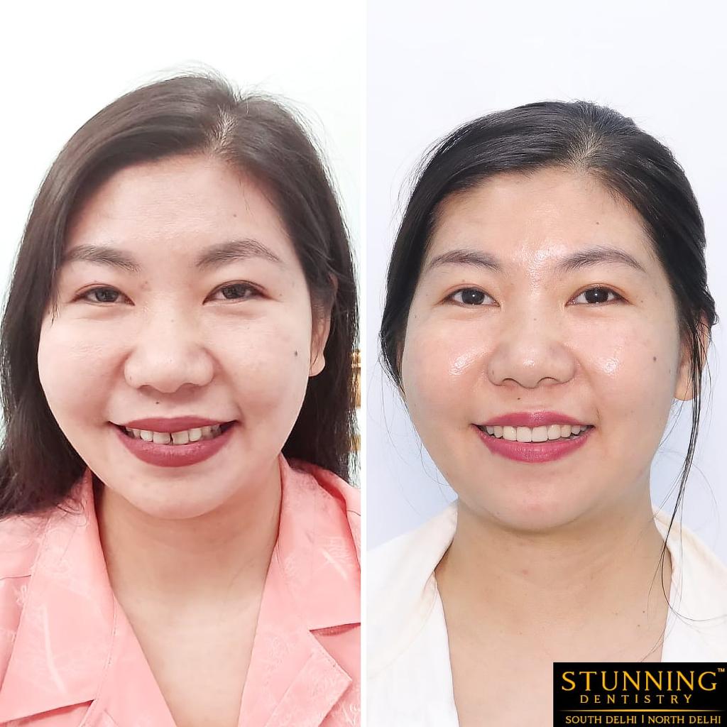 teeth correction results