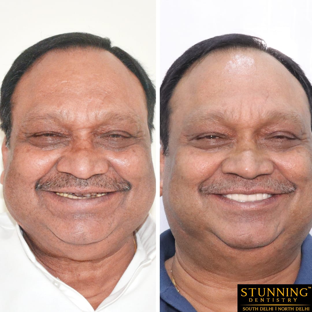 teeth correction results