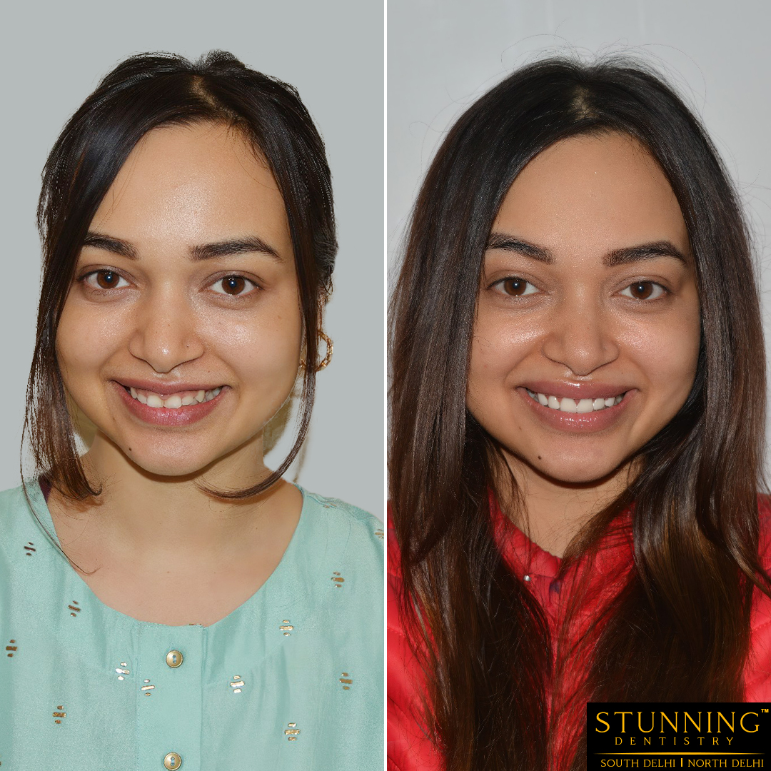 teeth correction results