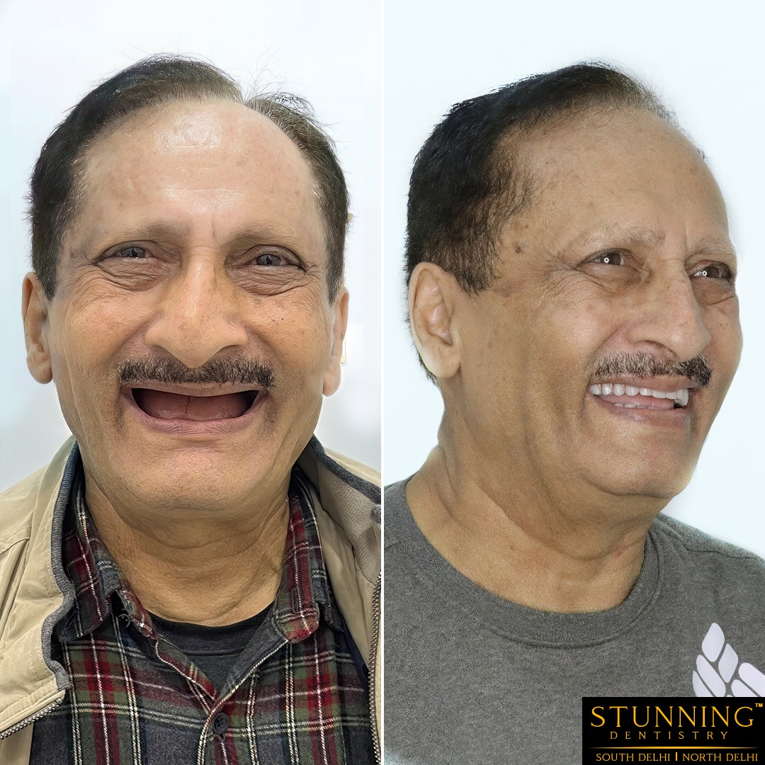 teeth correction results