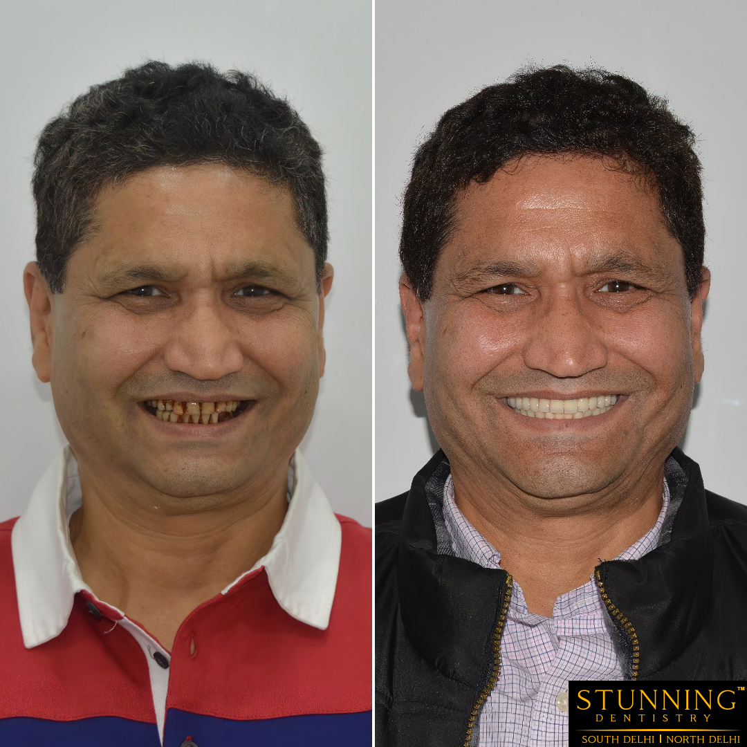 teeth correction results