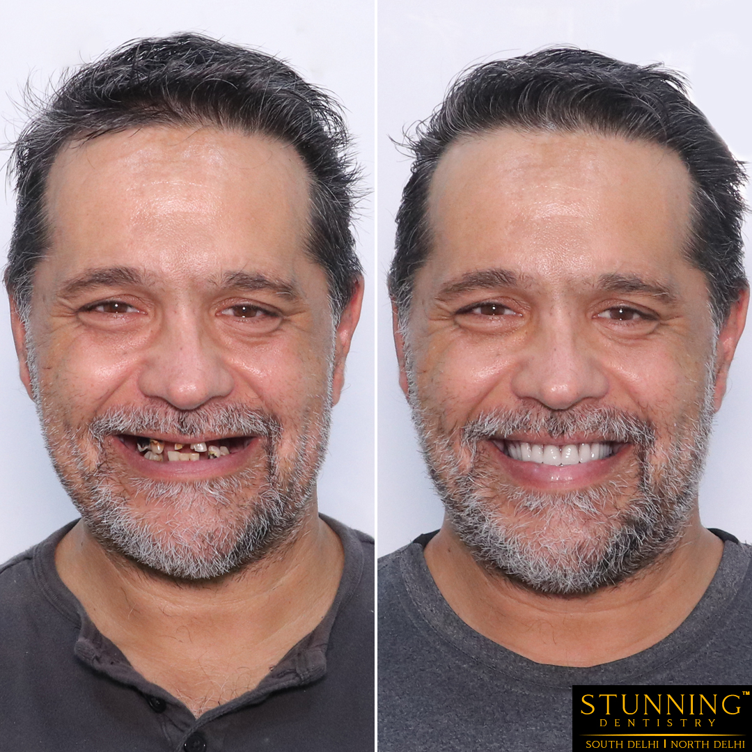 teeth correction results