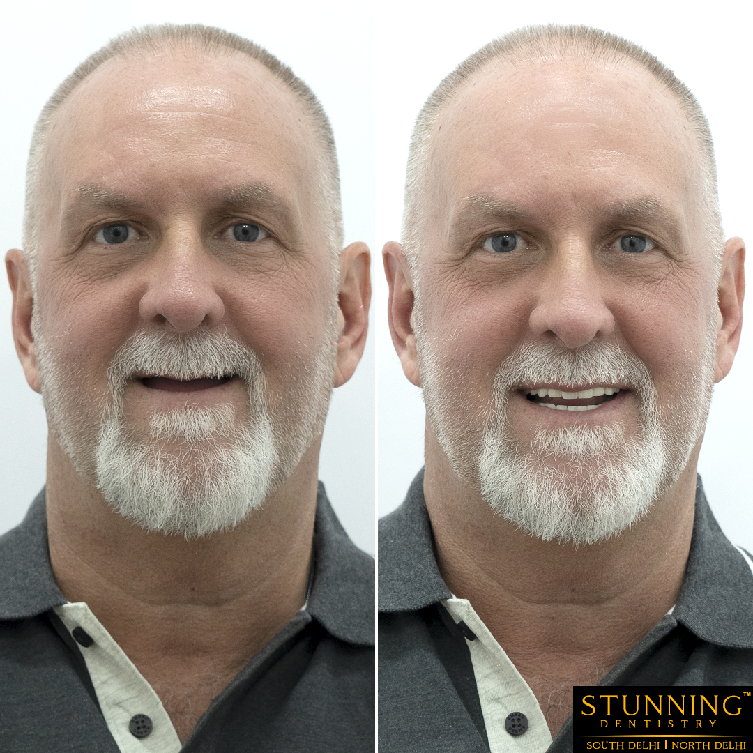 teeth correction results