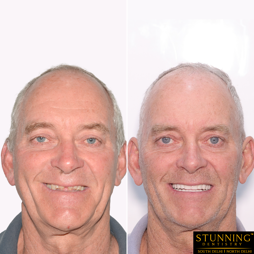 teeth correction results