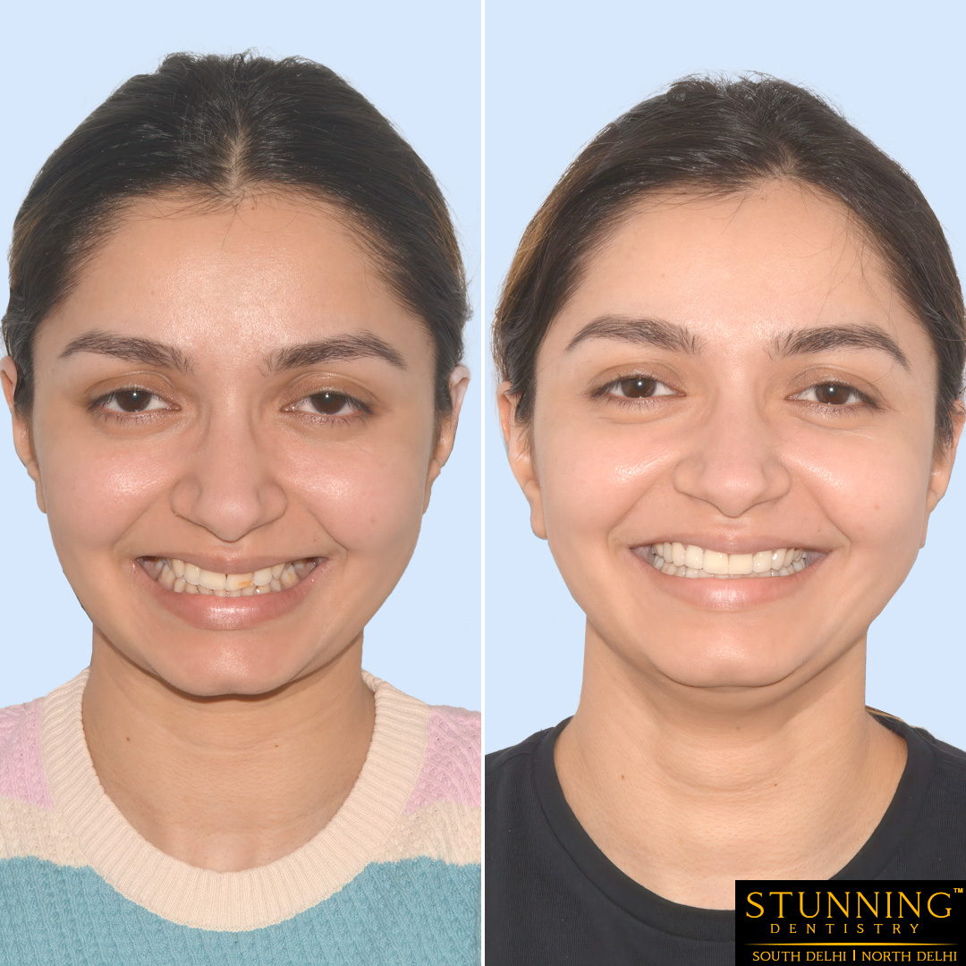 teeth correction results