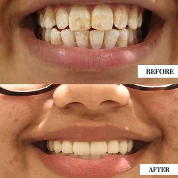 dental veneers treatment