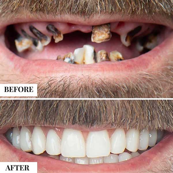 full mouth teeth transplant cost in india