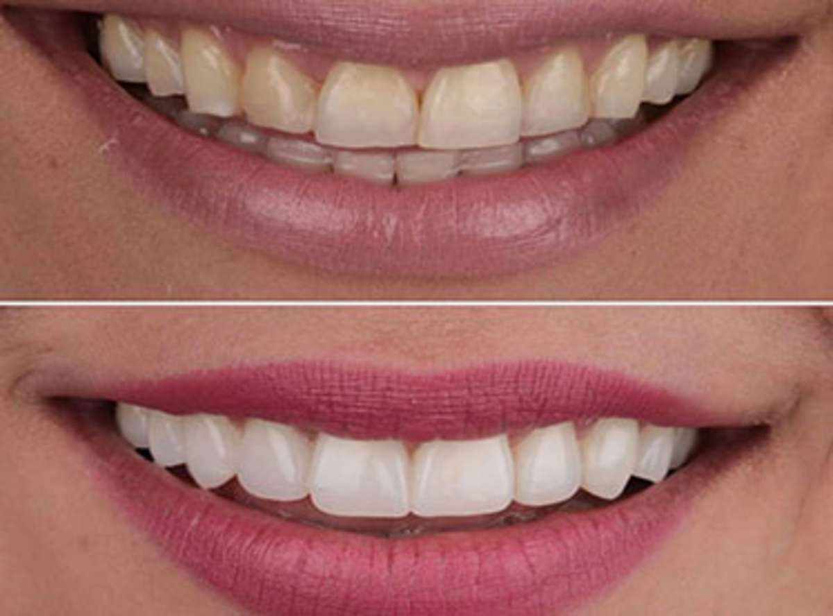 Porcelain(Composite) Veneers Delhi India Cost of Porcelain(Composite