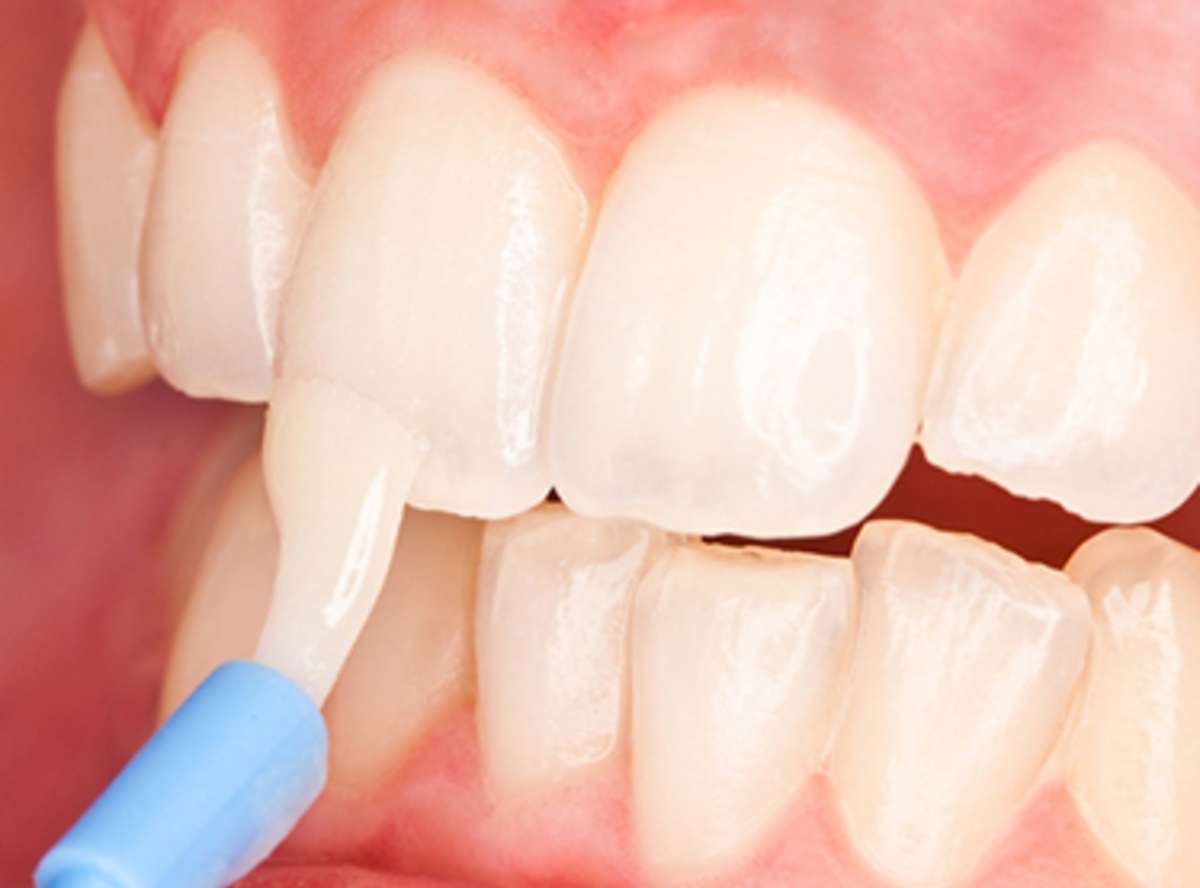 Teeth Fluoride Treatment Delhi India