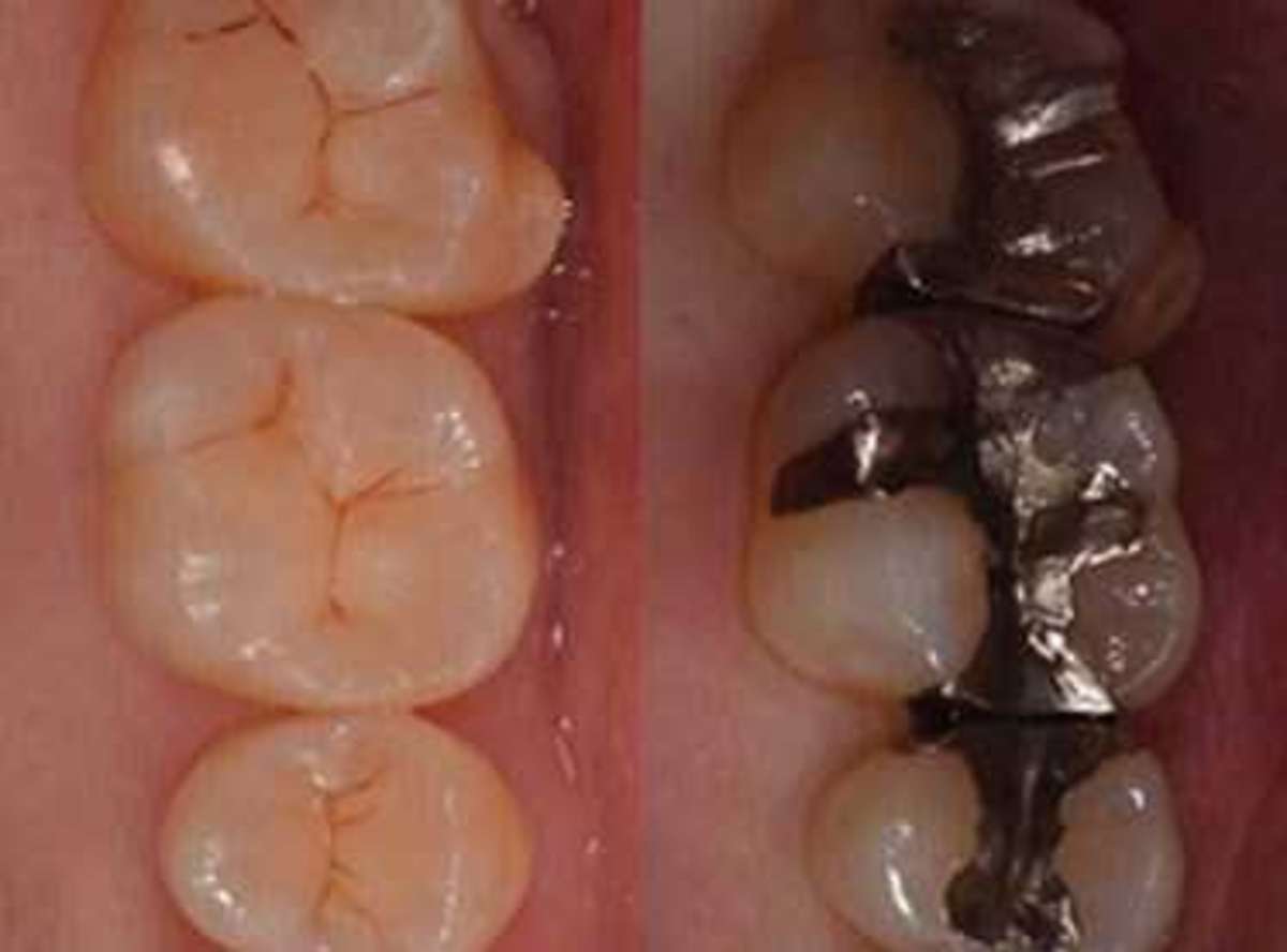 kids teeth restoration near about