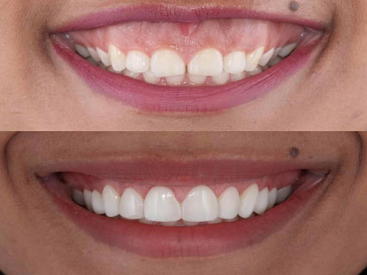 Gummy Smile Treatment Delhi India Cost of Gummy Smile Correction ...