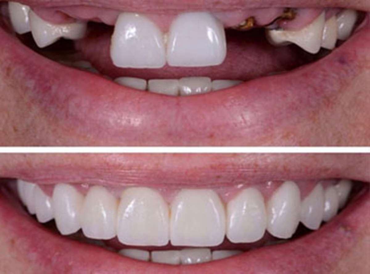 Missing Teeth Treatment and solution near me