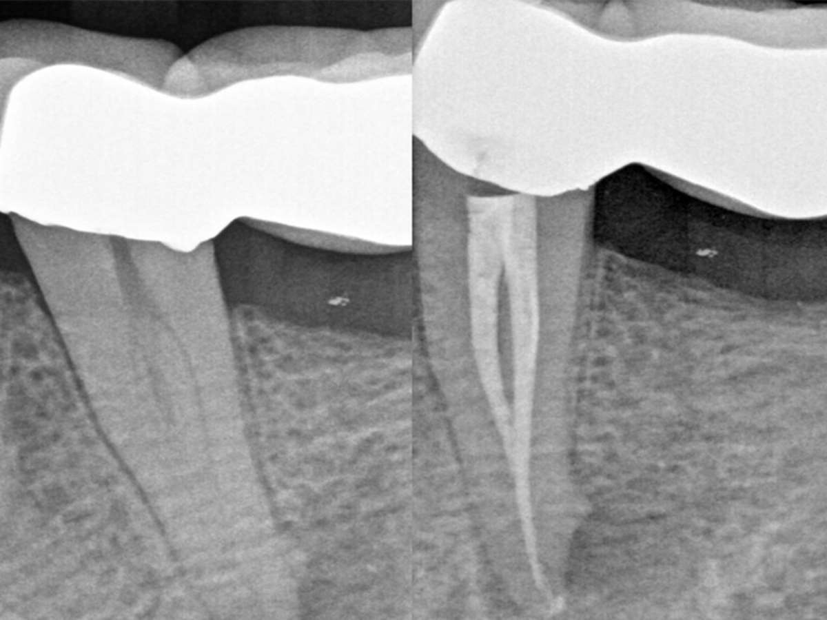 single sitting root canal Procedure