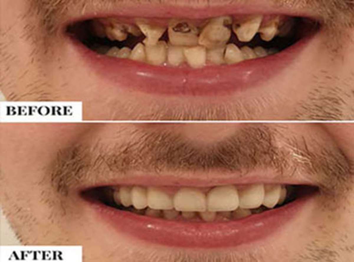 Best Way to Fix Crooked Teeth « Stunning Dentistry Blog