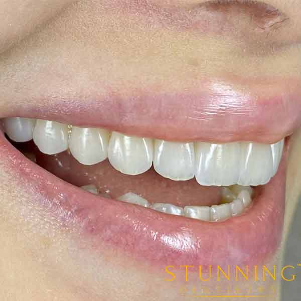 Get Get Same Day dental veneers near me Procedure, composite porcelain teeth price