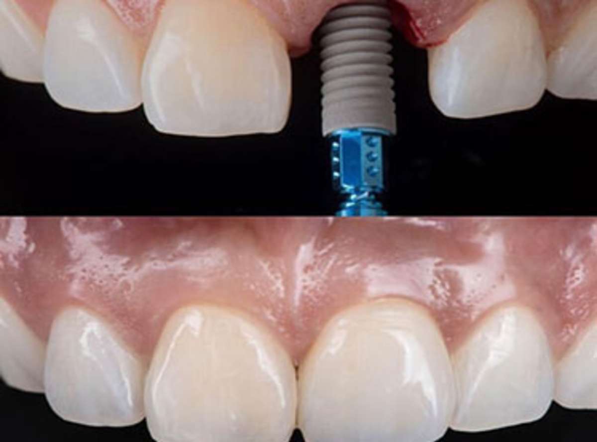 single tooth implant near me