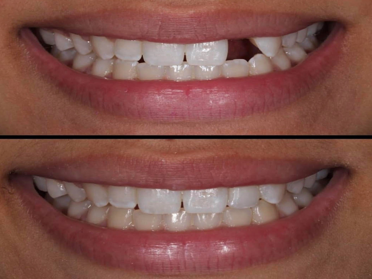 Teeth Treat: Cost for teeth whitening in india
