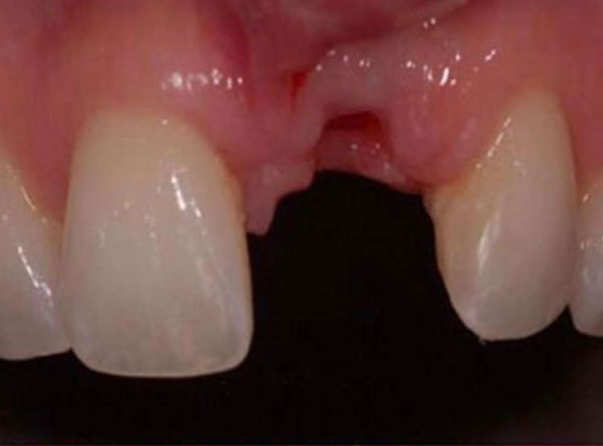 Grossly Decayed Tooth Extraction near me