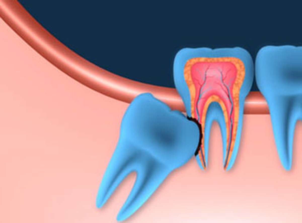 Wisdom Tooth: Pain, Symptoms, and Treatment « Stunning Dentistry Blog