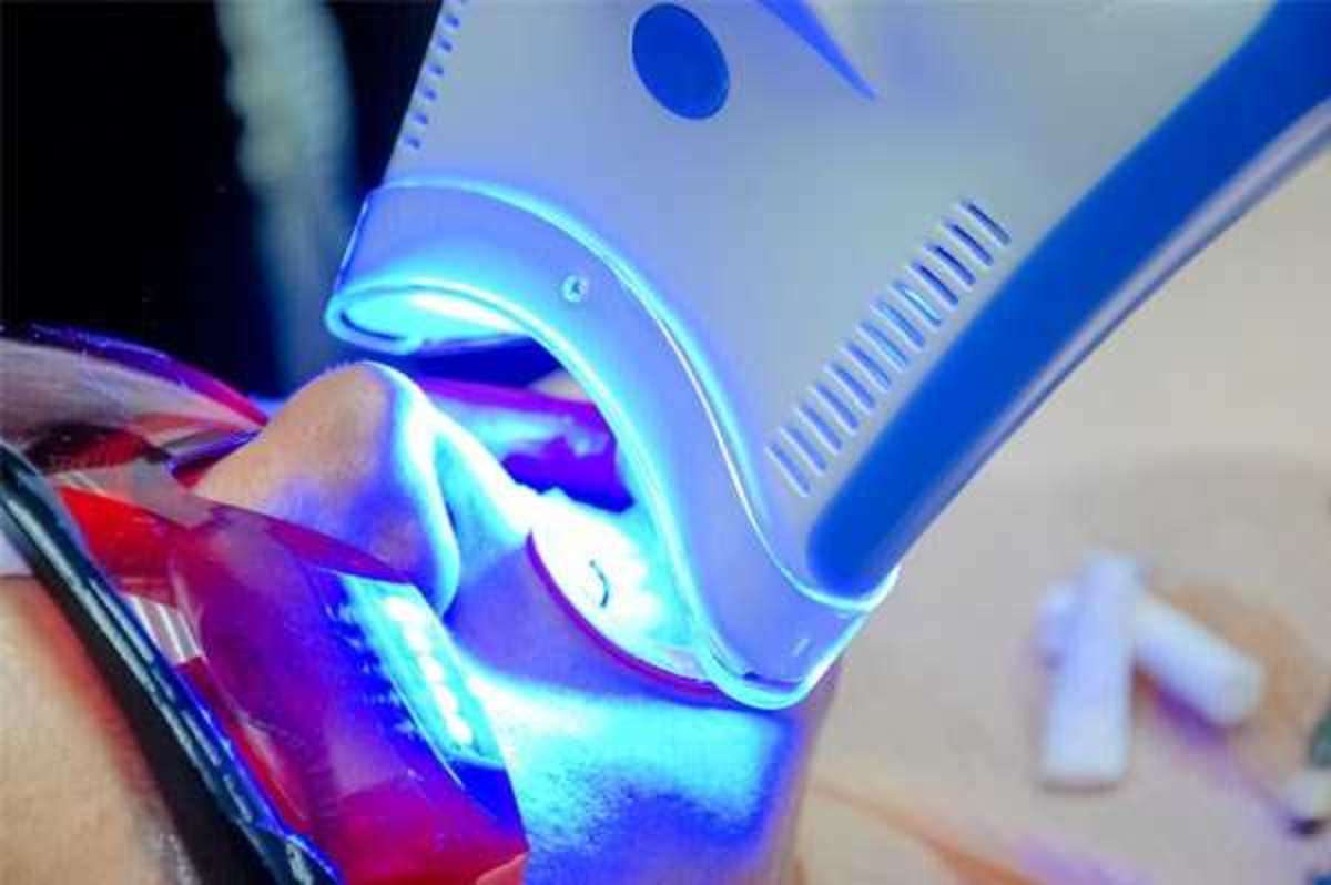 Instant teeth whitening treatment