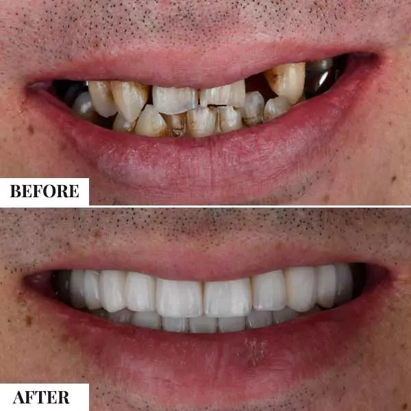 full teeth replacement cost Civil Lines india