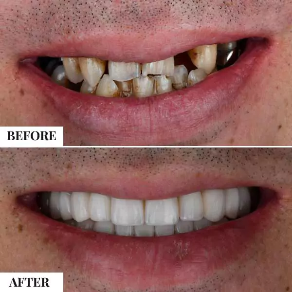 full teeth replacement cost india