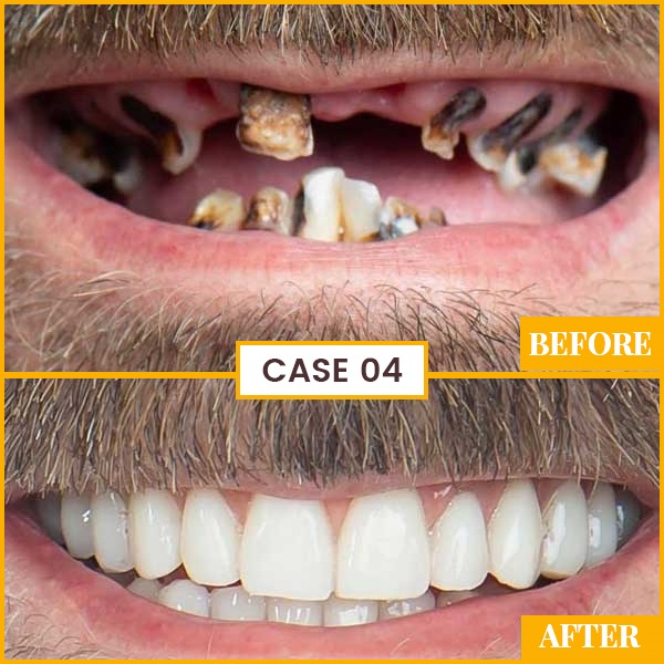 cost of full mouth teeth plantation in india