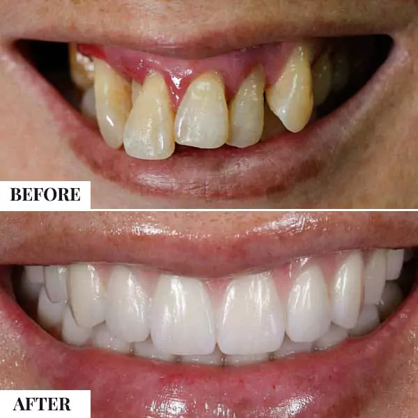 cost of full mouth teeth plantation in india