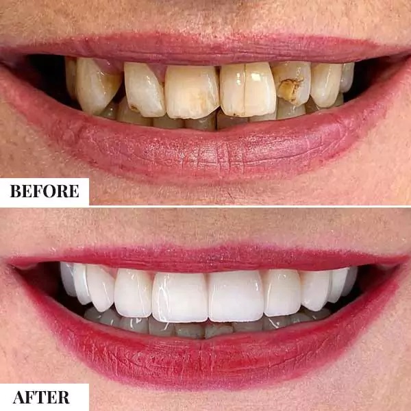 full mouth teeth transplant cost in india