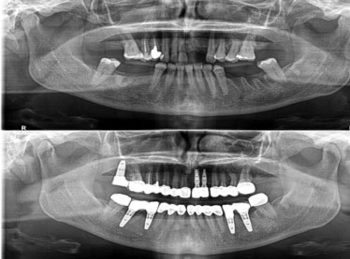 how much does it cost to get a full mouth of dental implants