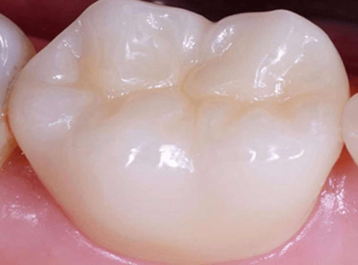 Pit & Fissure Sealants in India