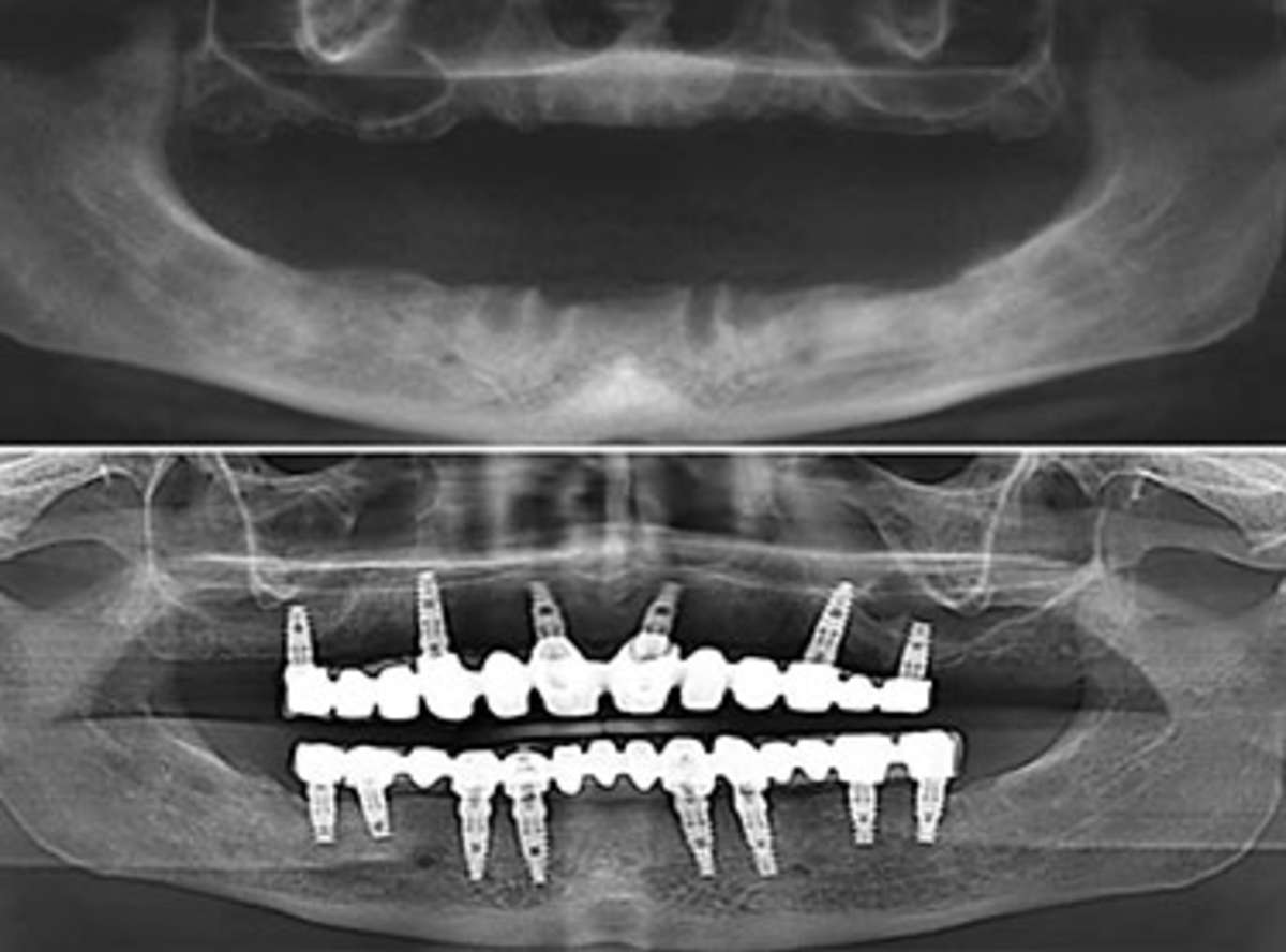 how much do All On 6/8 dental implants cost