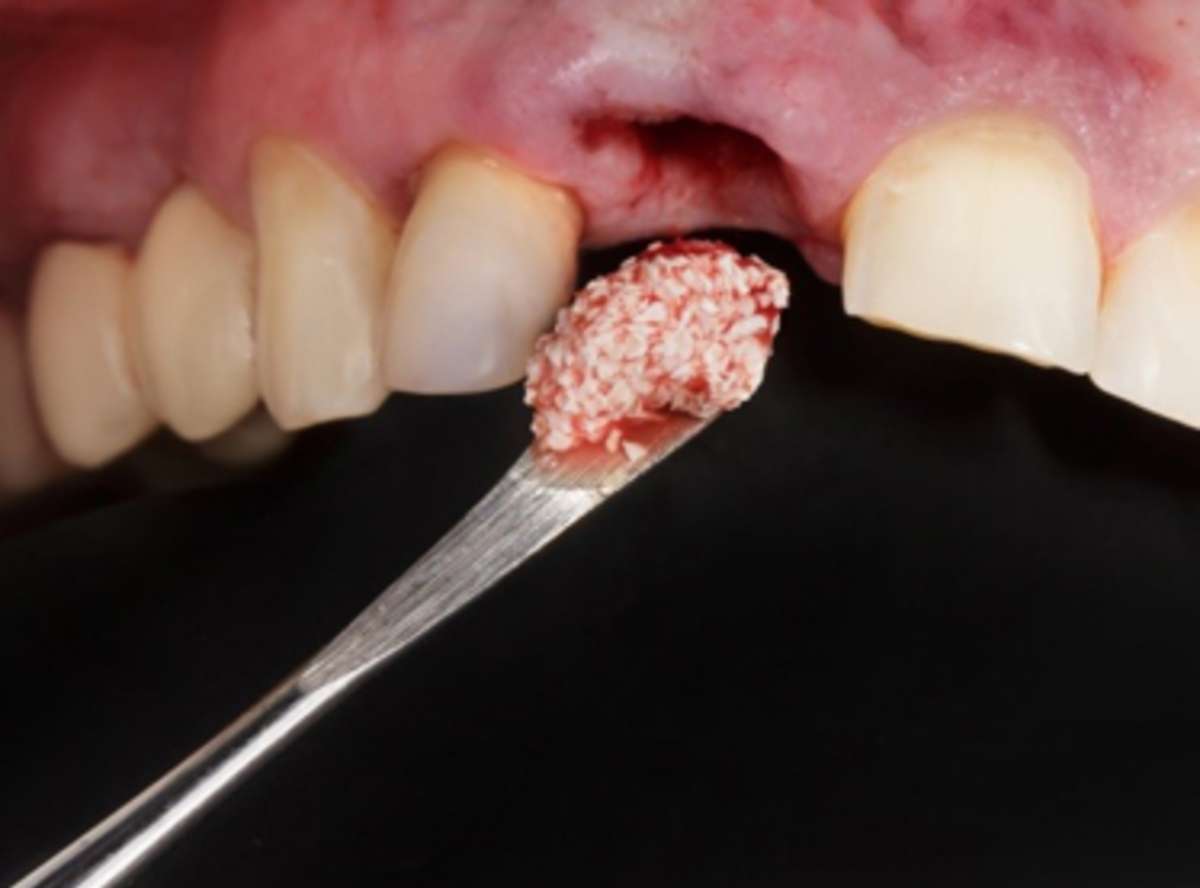 Bone Grafting