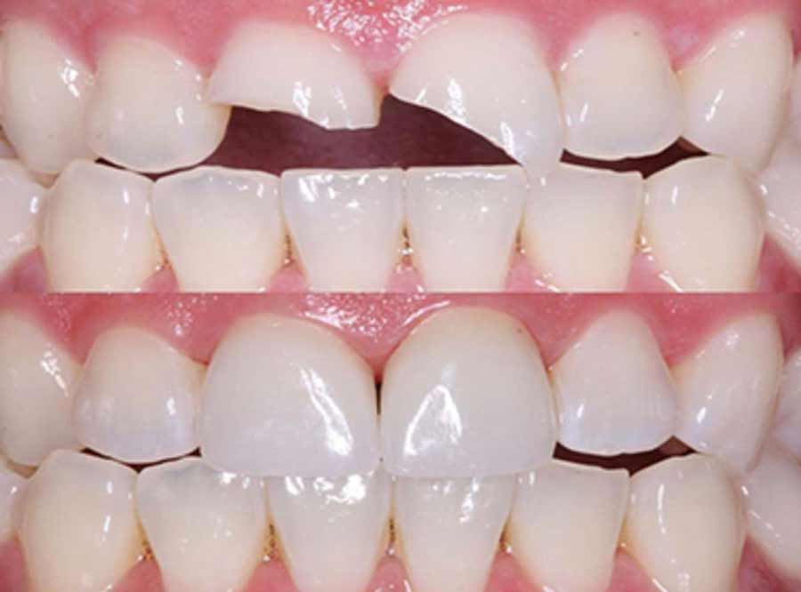 Composite dental Bonding nearby