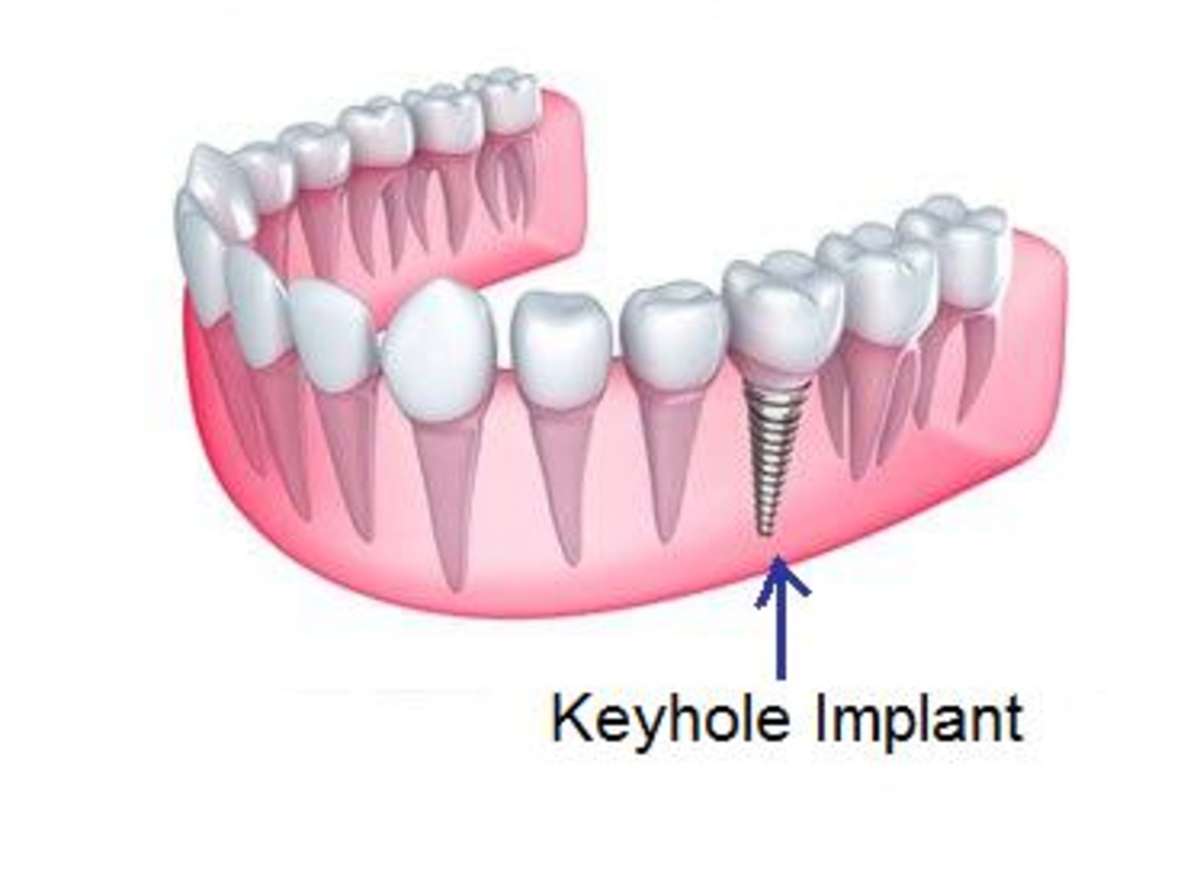 best Keyhole Dental Implants implantologist in india 