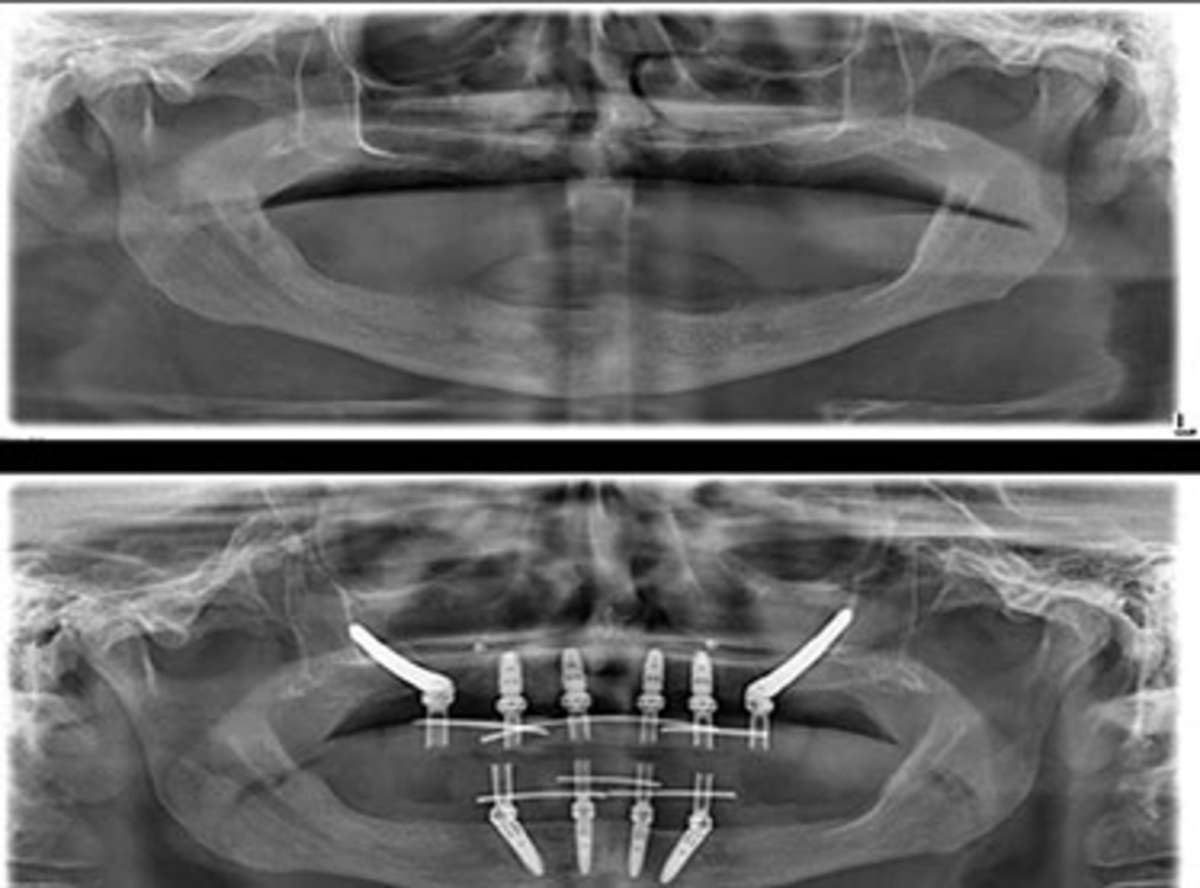 Zygomatic Implants in malviya nagar india