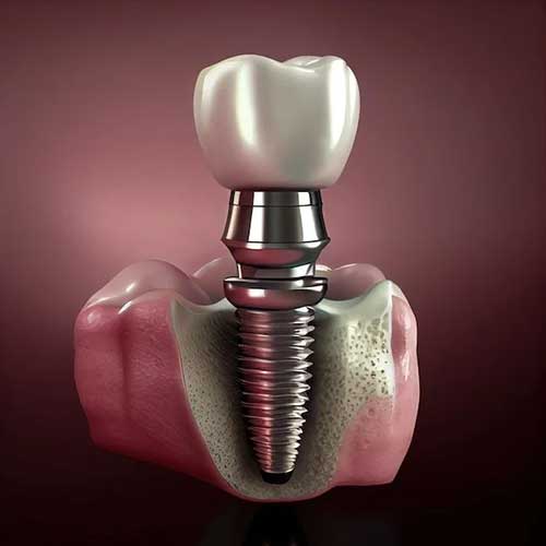 Osstem Implants charges