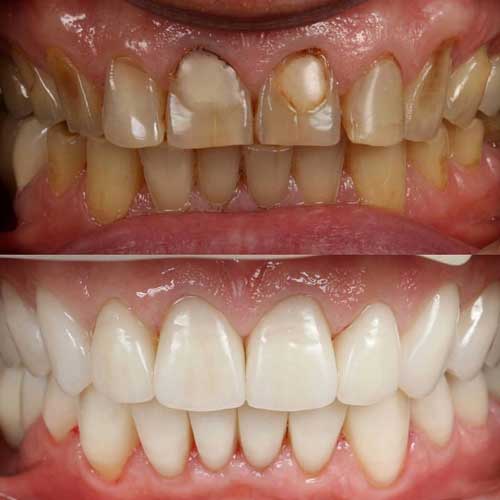 lowest cost of dental implants delhi